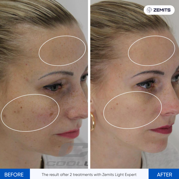 Zemits Light Expert 2.0 Macchina Laser IPL