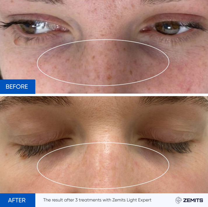 Zemits Light Expert 2.0 Macchina Laser IPL
