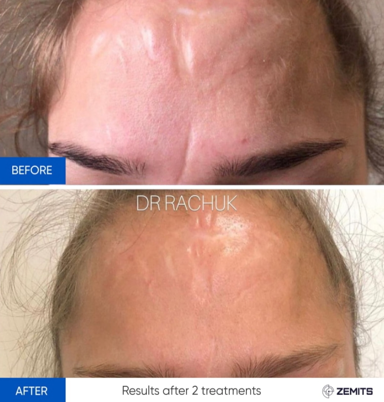 Zemits CarbonFrax Pro: Laser Frazionale CO2