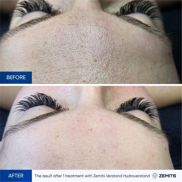 Zemits HydroVerstand PRO Sistema 7-in-1 HydroDiamond™