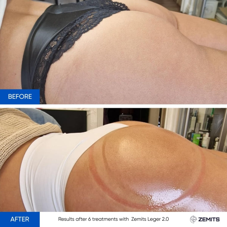 Zemits Leger 2.0 Sistema di Coppettazione a Vuoto con Coppe XXL nel Set