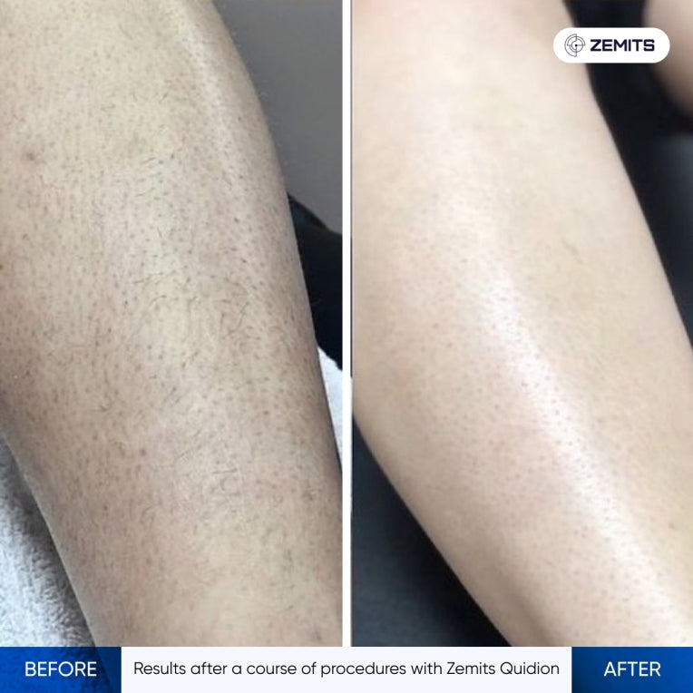 Zemits Quidion Laser a Diodo per la Rimozione dei Peli