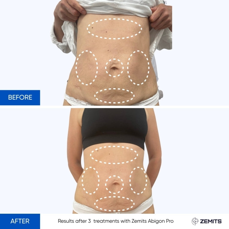 Zemits Abigon Pro Sistema di Rimodellamento Corporeo e Snellimento Ultimativo