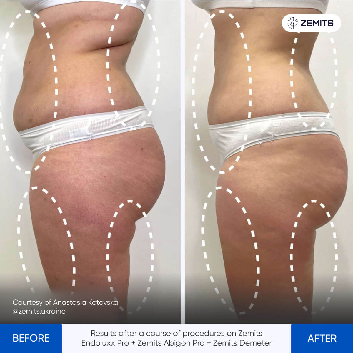 Before After Slide 1