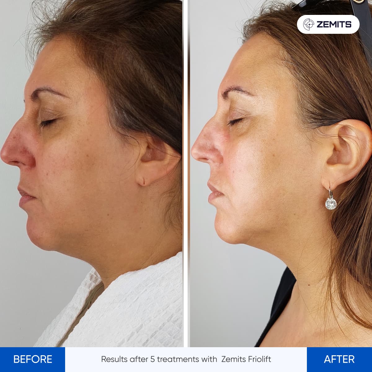 Before After Slide 15