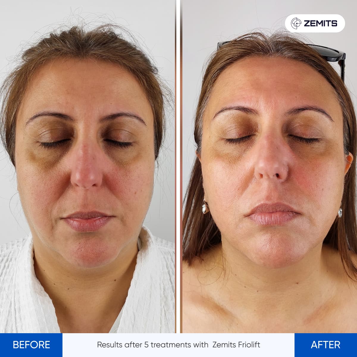 Before After Slide 16