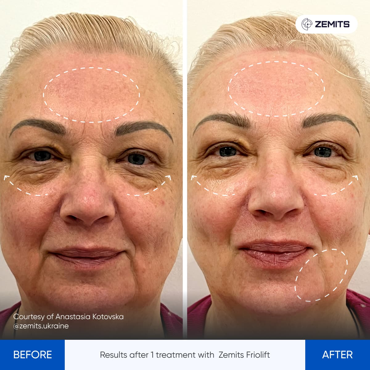 Before After Slide 18