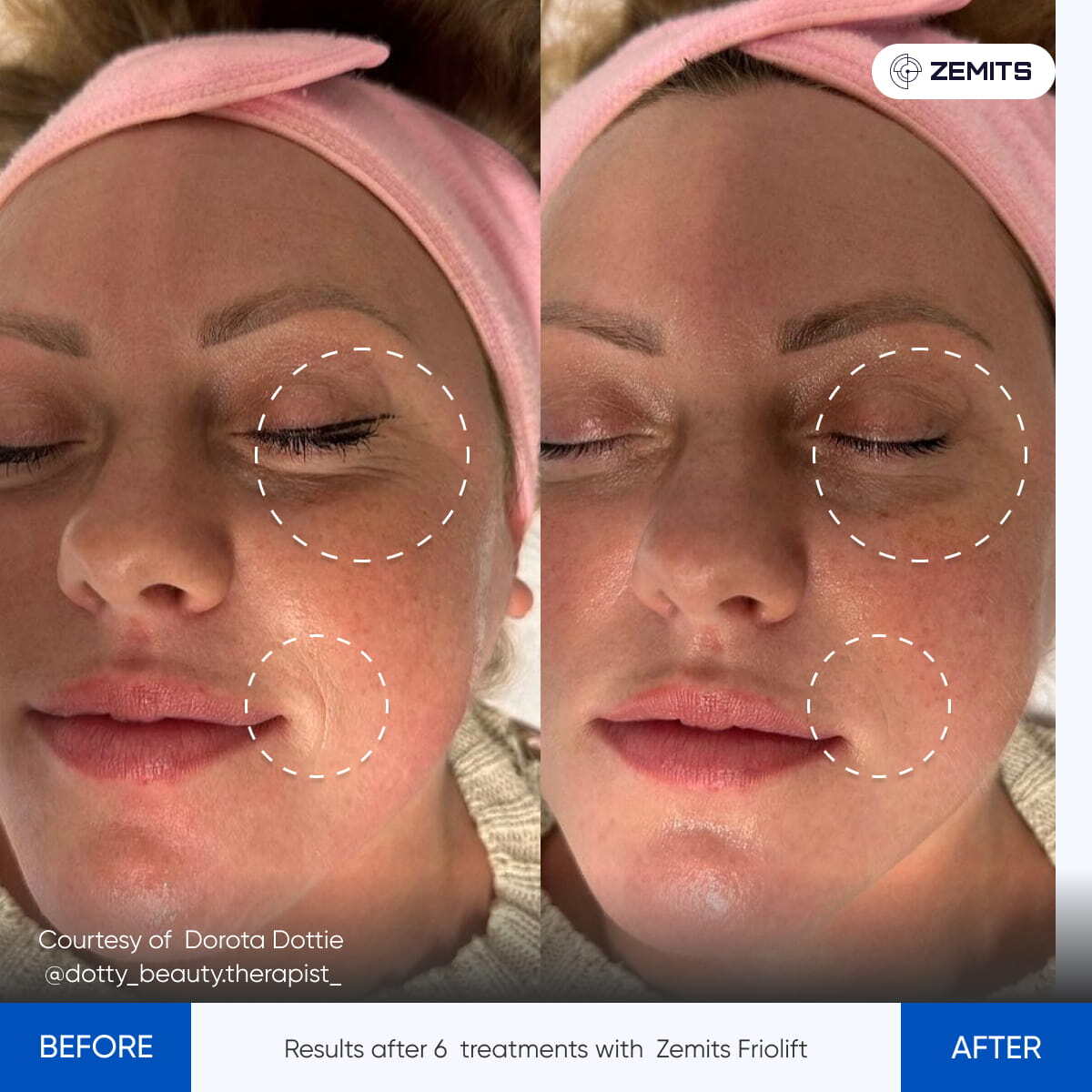 Before After Slide 20
