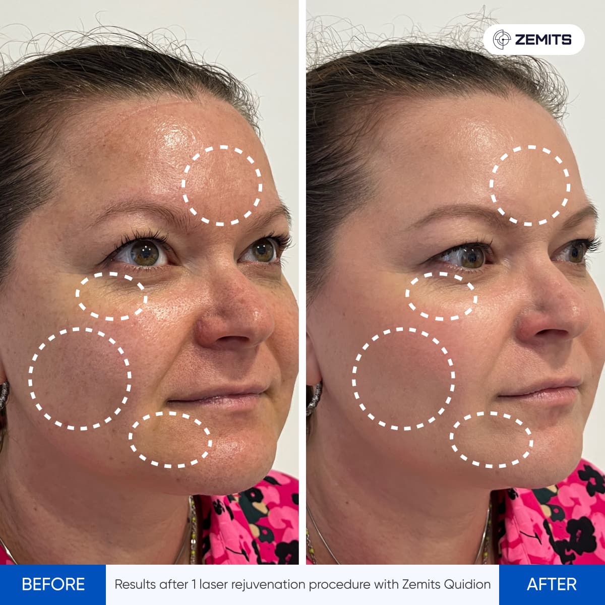 Before After Slide 11