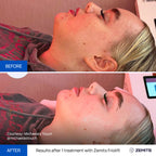 Before and after RF cryo treatment results Zemits FrioLift