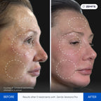 Before and after facial rejuvenation Zemits Verstand Pro