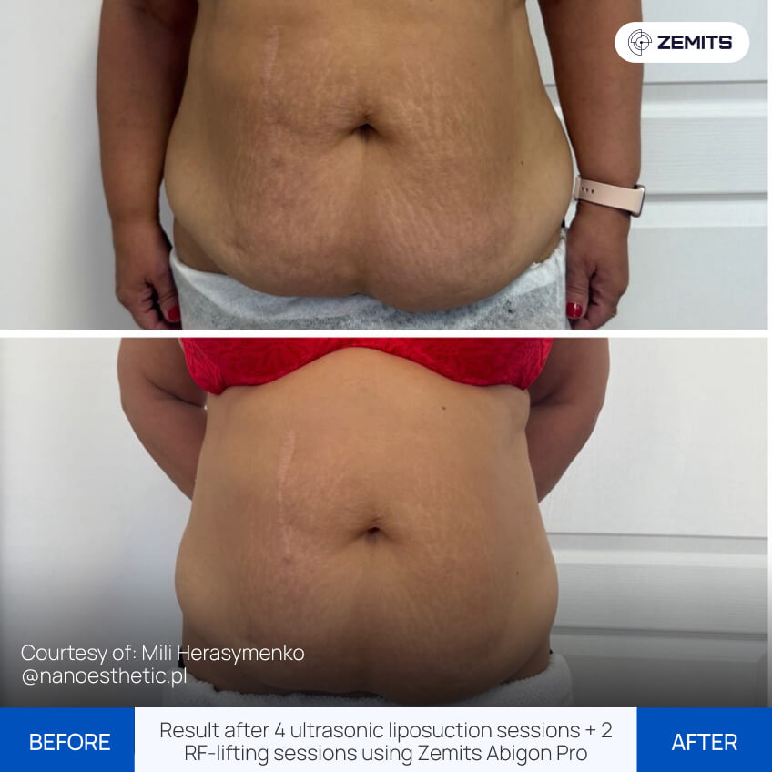 Before After Slide 3