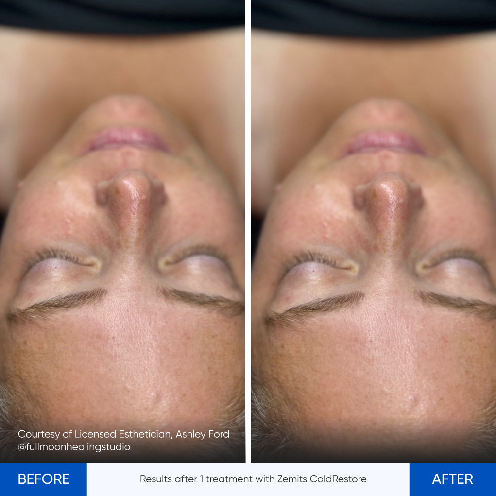 Before After Slide 23