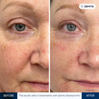 Before and after facial rejuvenation Zemits Verstand Pro