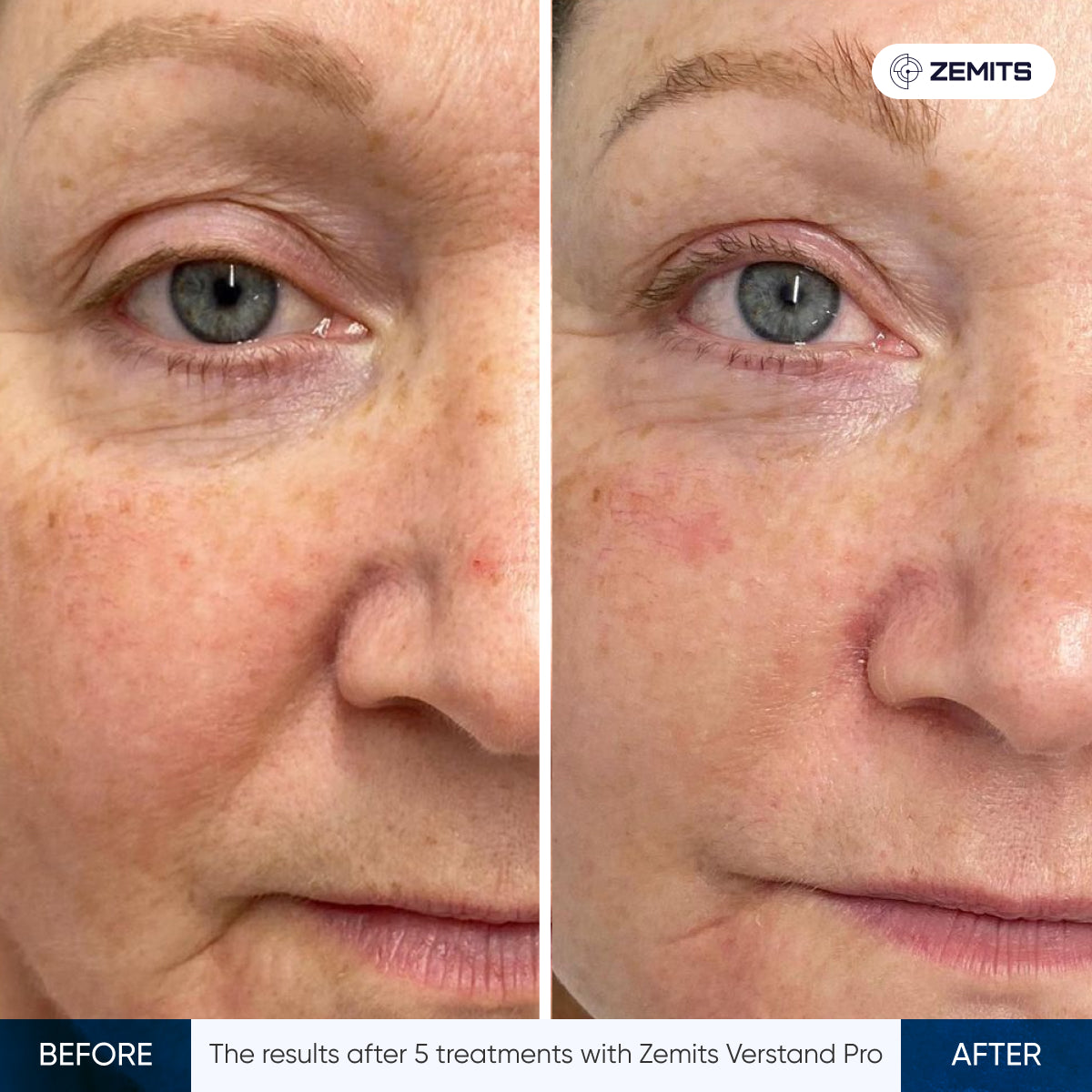 Before and after facial rejuvenation Zemits Verstand Pro