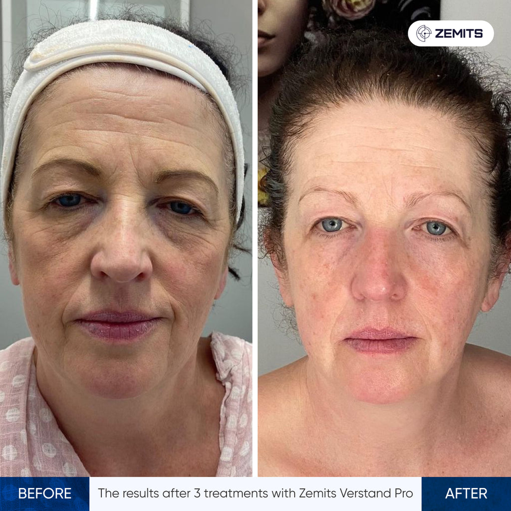 Before and after facial rejuvenation Zemits Verstand Pro
